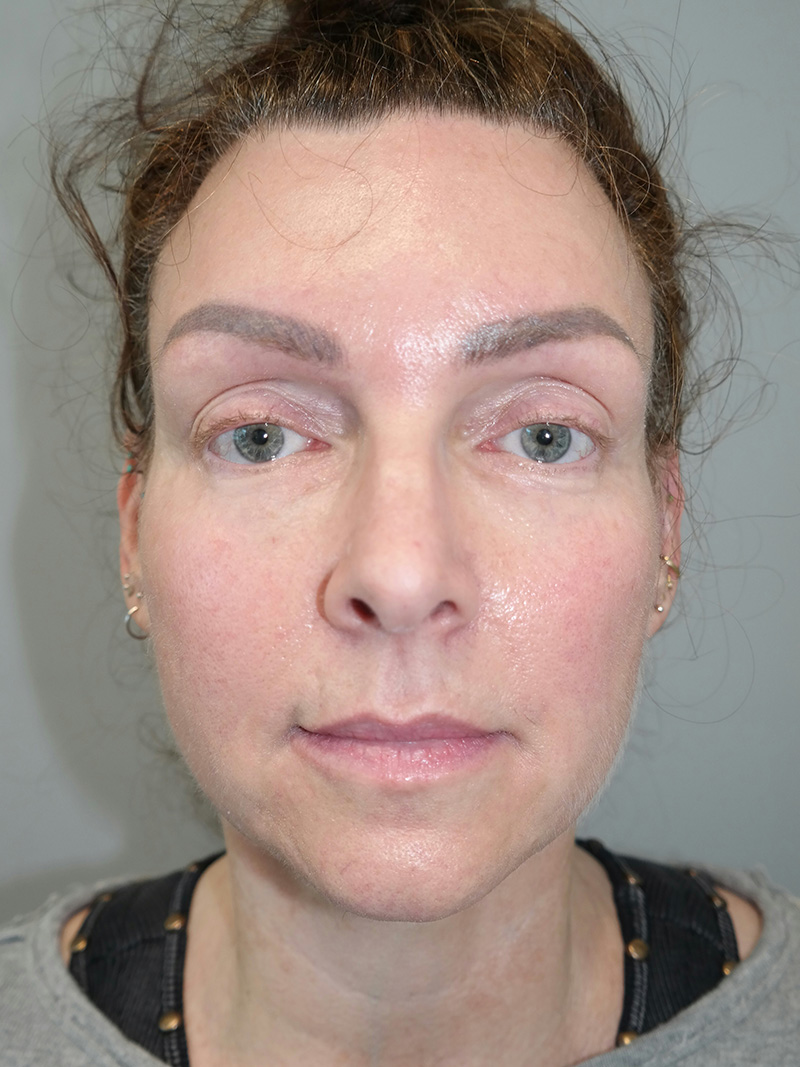 Facelift Before and After 16 | Sanjay Grover MD FACS