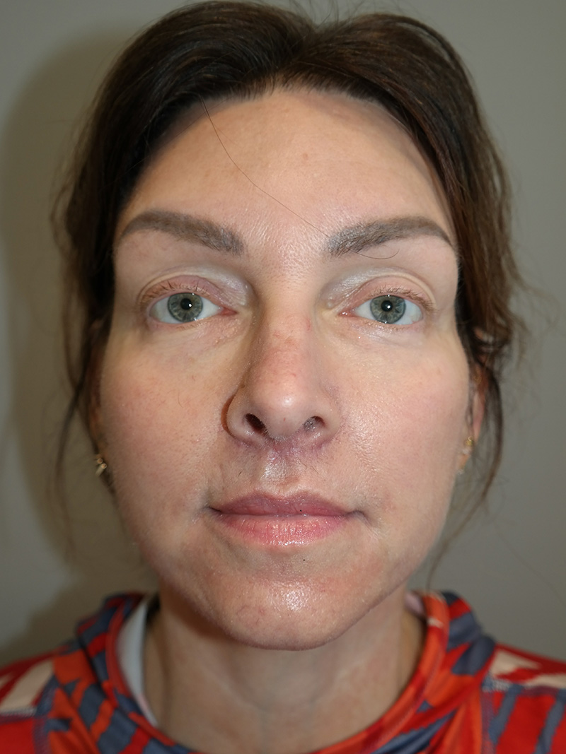 Facelift Before and After 16 | Sanjay Grover MD FACS