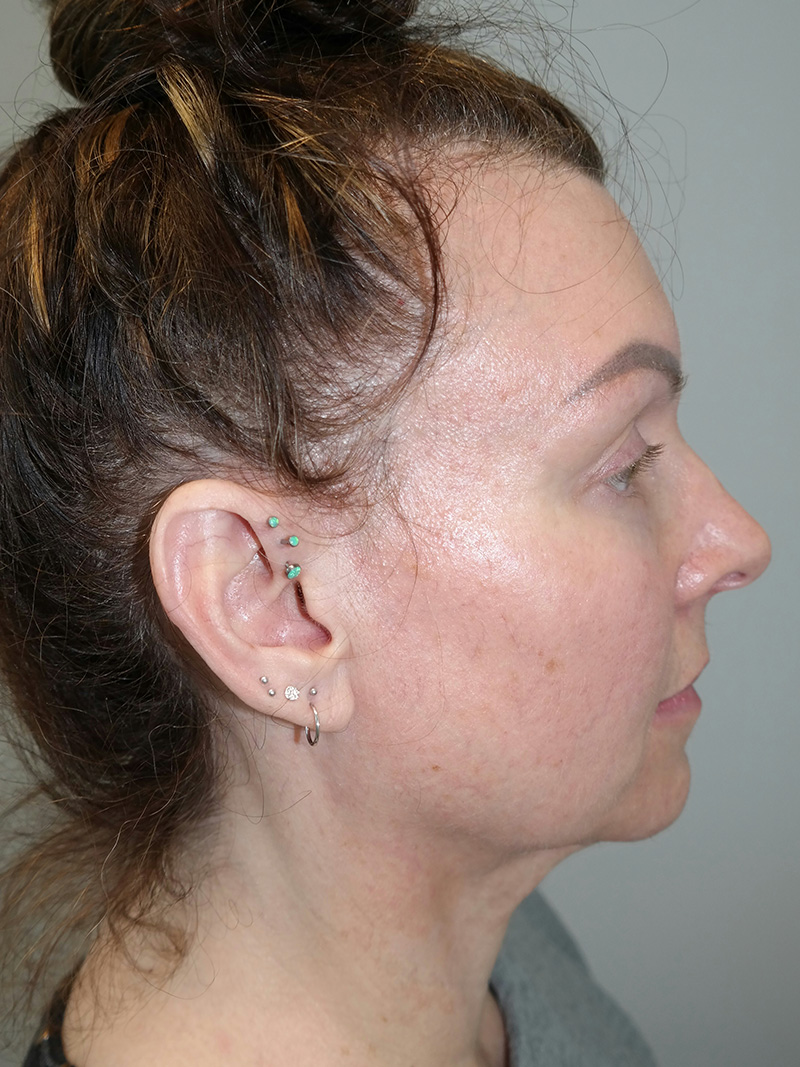 Facelift Before and After 16 | Sanjay Grover MD FACS