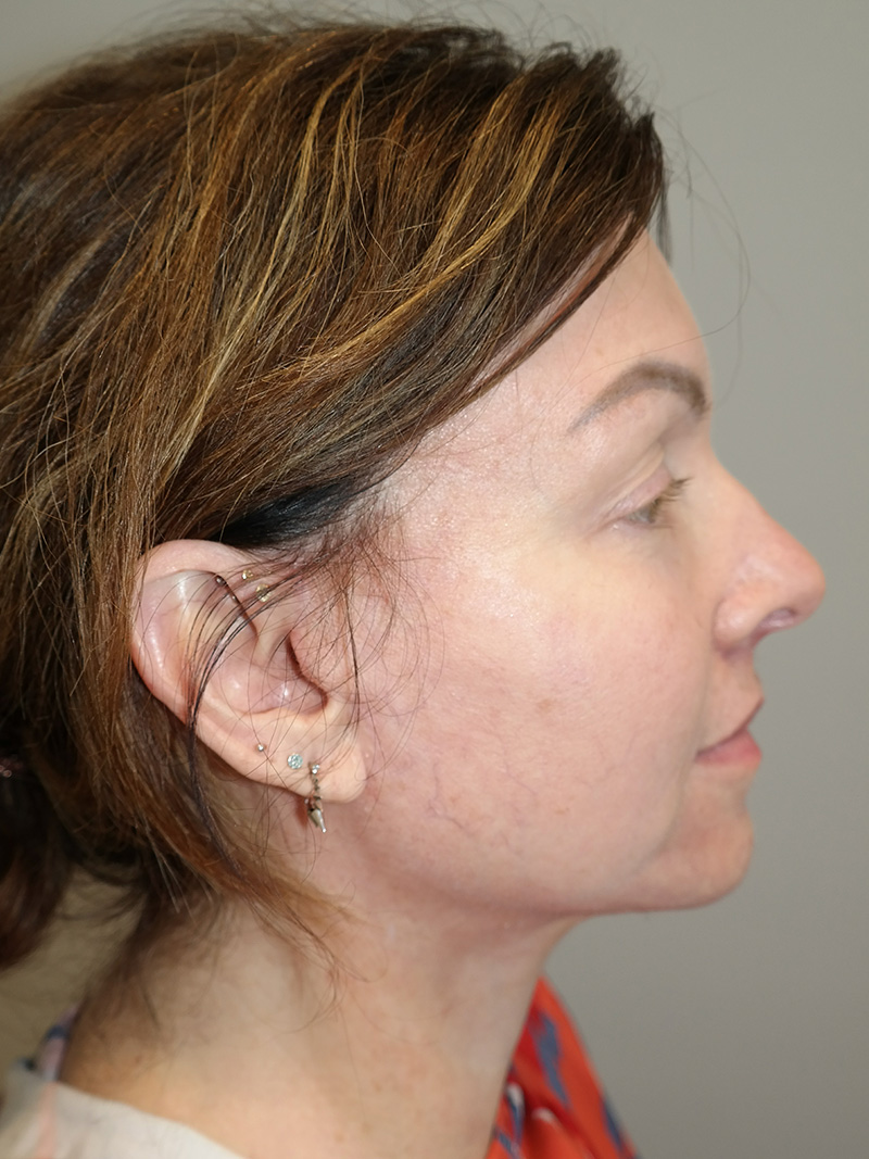 Facelift Before and After 16 | Sanjay Grover MD FACS