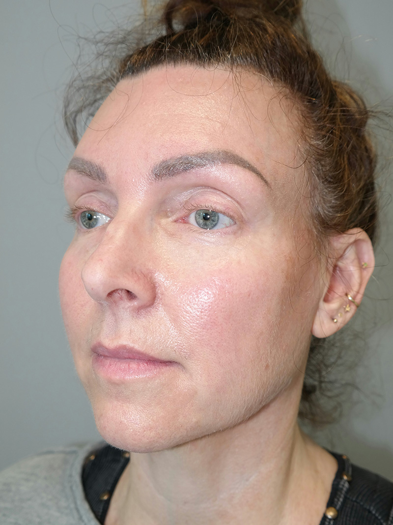 Facelift Before and After 16 | Sanjay Grover MD FACS