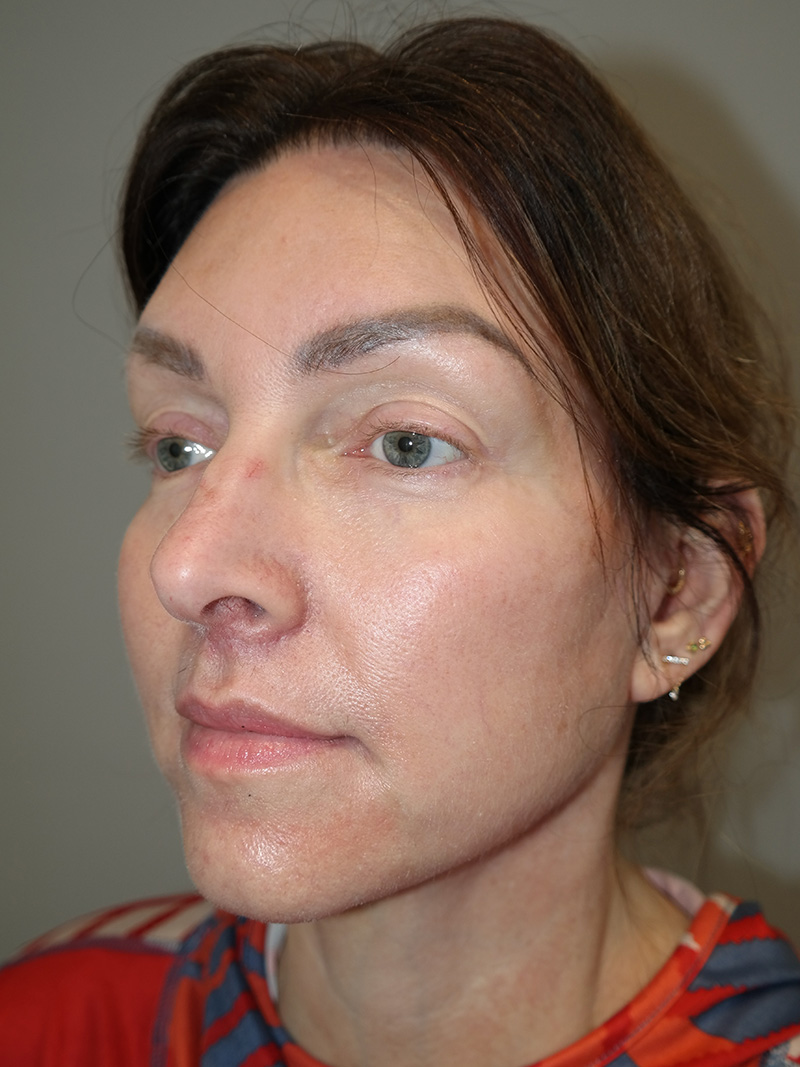 Facelift Before and After 16 | Sanjay Grover MD FACS