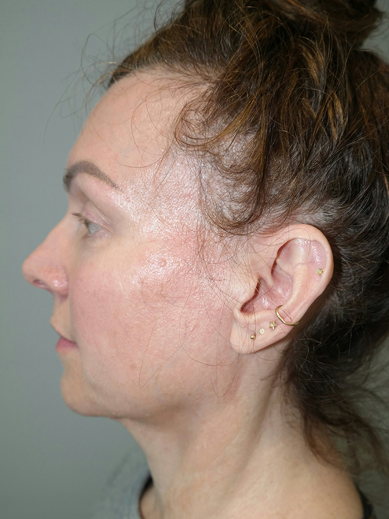 Facelift Before and After 16 | Sanjay Grover MD FACS