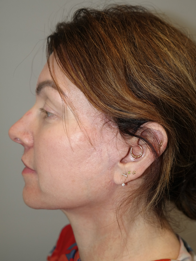 Facelift Before and After 16 | Sanjay Grover MD FACS