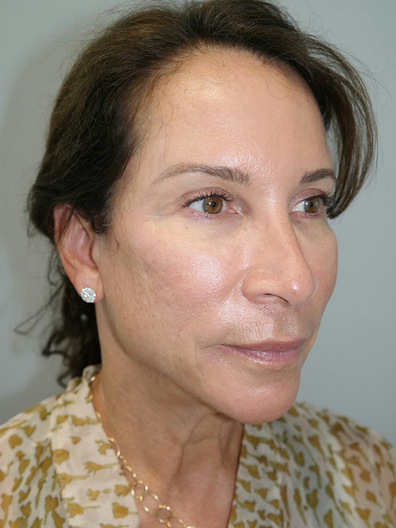 Facelift Before and After 29 | Sanjay Grover MD FACS