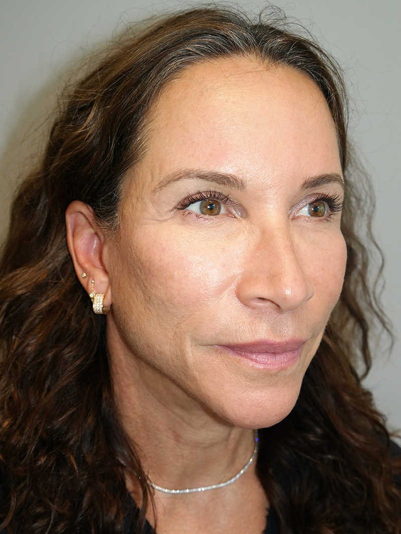 Facelift Before and After | Grover Aesthetics