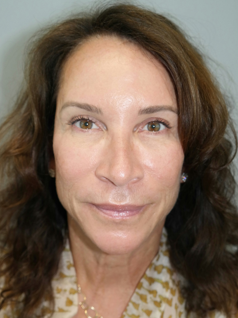 Facelift Before and After 17 | Sanjay Grover MD FACS