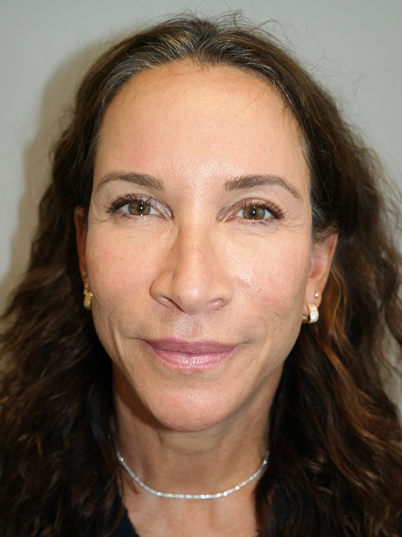 Facelift Before and After 17 | Sanjay Grover MD FACS