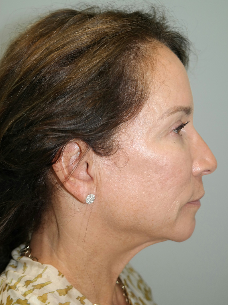 Facelift Before and After 17 | Sanjay Grover MD FACS