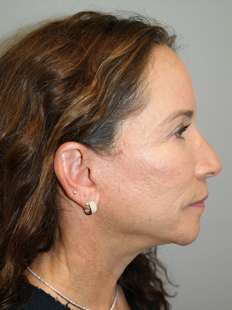 Facelift Before and After 17 | Sanjay Grover MD FACS