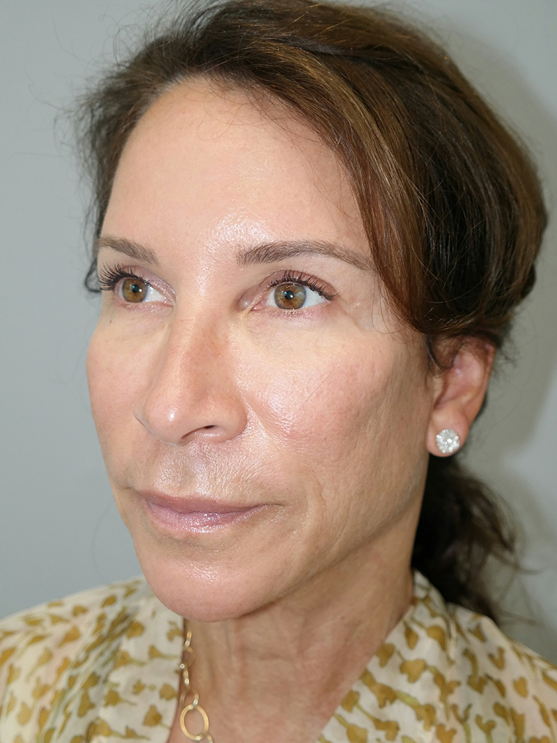 Facelift Before and After 17 | Sanjay Grover MD FACS