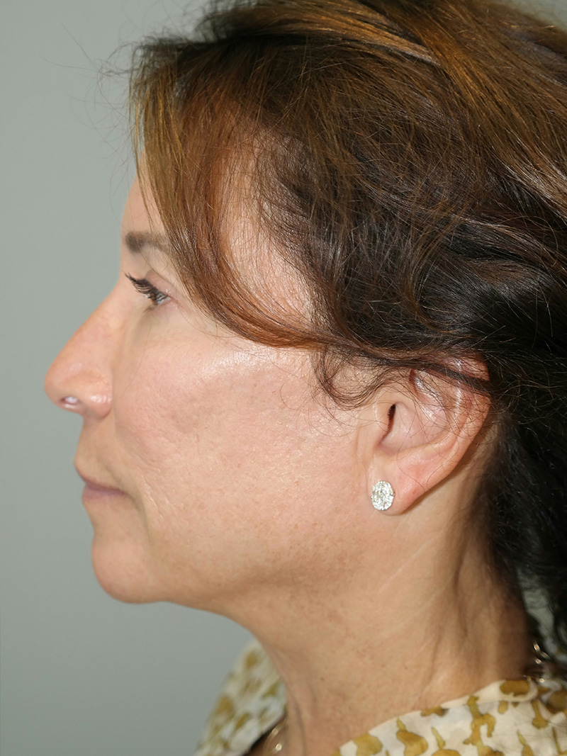 Facelift Before and After 17 | Grover Aesthetics