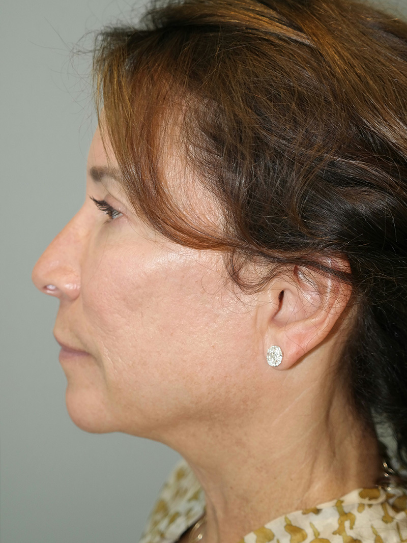 Facelift Before and After 17 | Sanjay Grover MD FACS