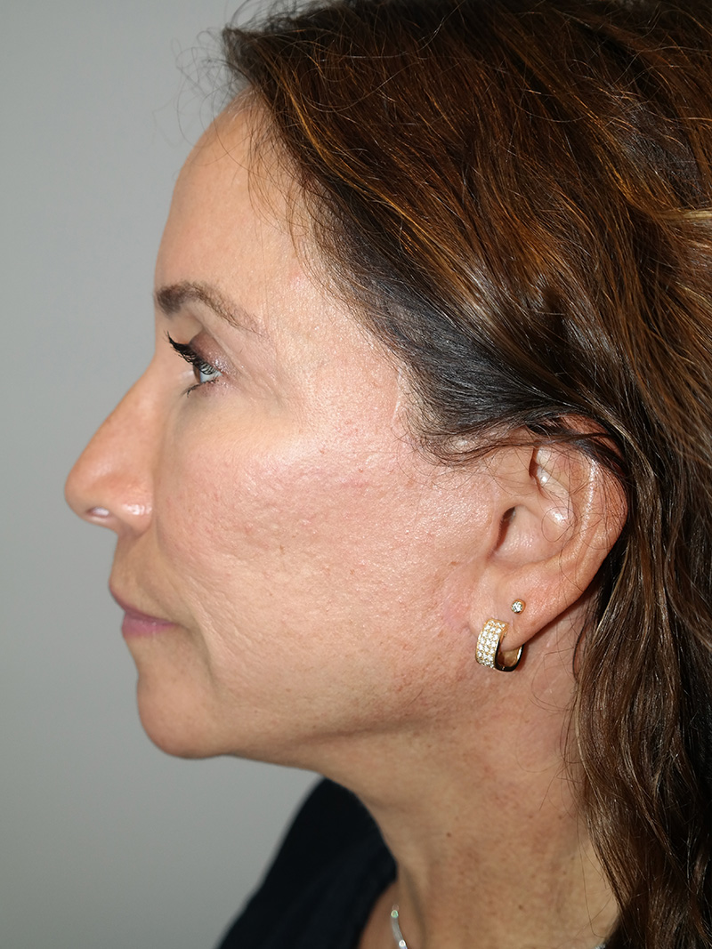 Facelift Before and After 17 | Sanjay Grover MD FACS