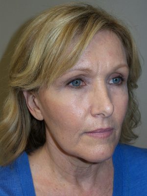 Facelift Before and After | Grover Aesthetics