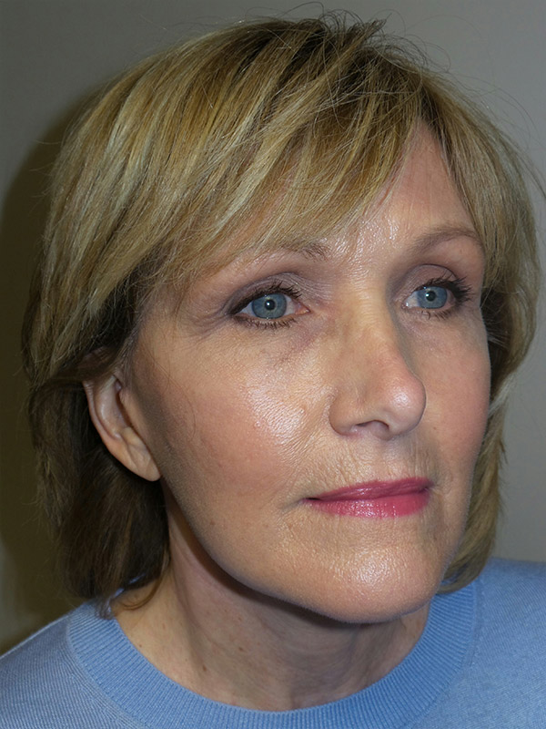 Facelift Before and After | Grover Aesthetics