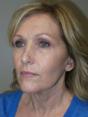 Facelift Before and After 18 | Grover Aesthetics