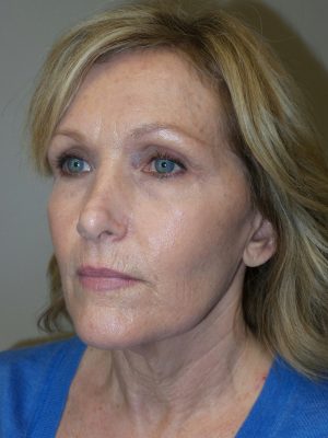 Facelift Before and After 18 | Sanjay Grover MD FACS