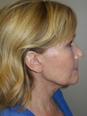 Facelift Before and After 18 | Sanjay Grover MD FACS