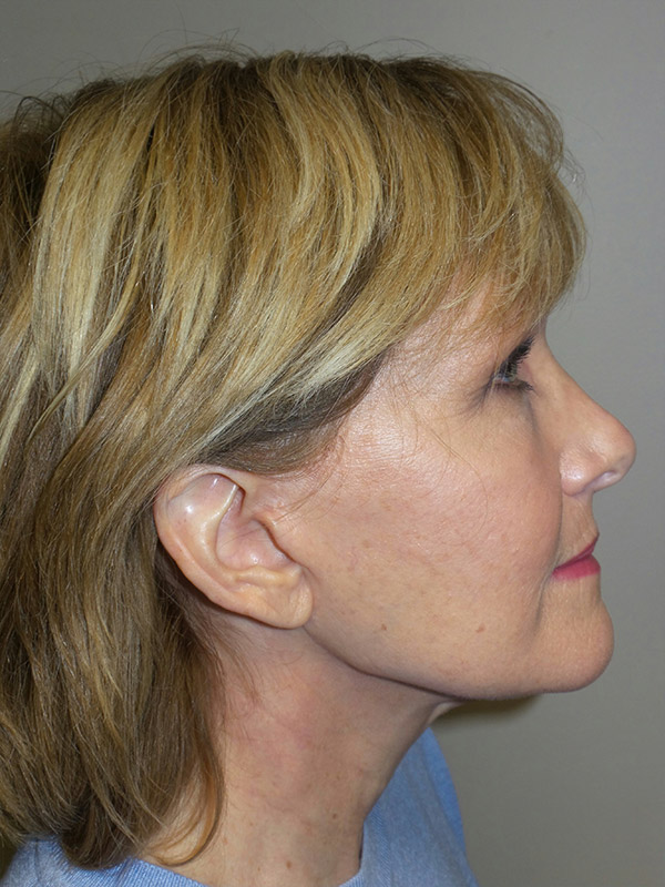 Facelift Before and After 18 | Sanjay Grover MD FACS