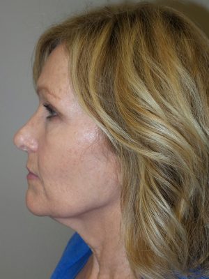 Facelift Before and After 18 | Sanjay Grover MD FACS