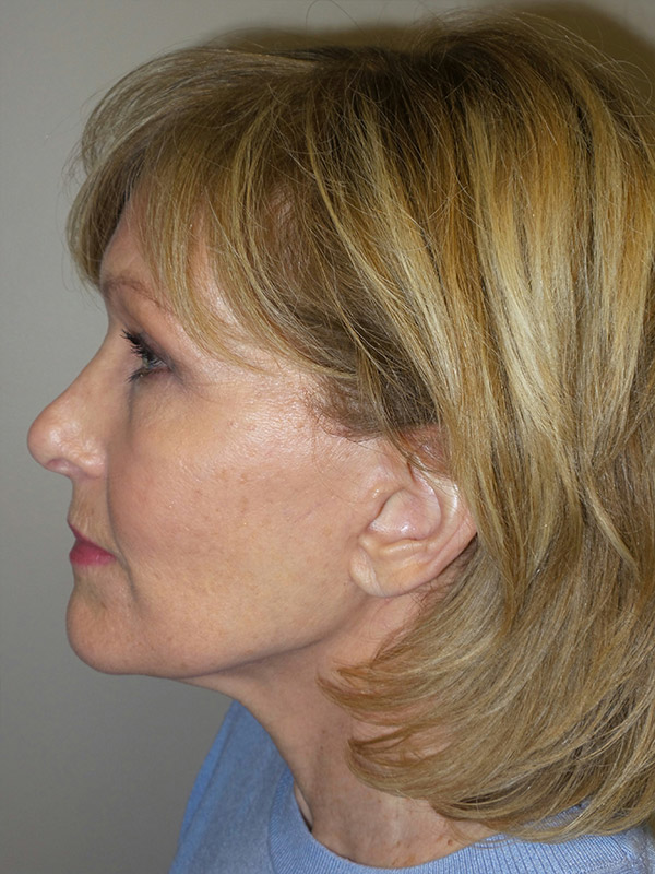 Facelift Before and After 18 | Sanjay Grover MD FACS