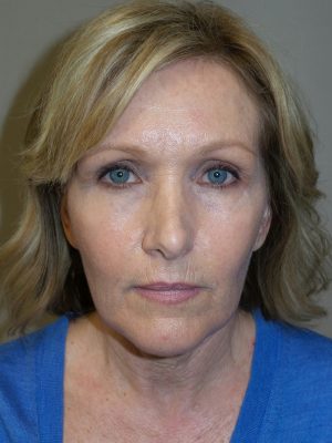 Facelift Before and After 18 | Sanjay Grover MD FACS