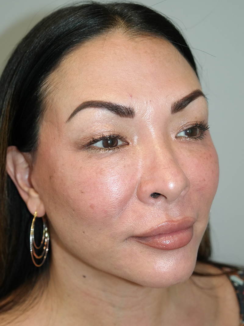 Facelift Before and After 19 | Sanjay Grover MD FACS