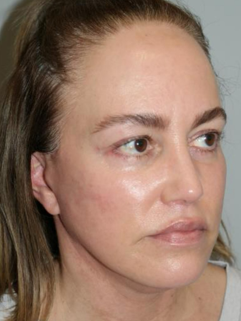 Facelift Before and After | Sanjay Grover MD FACS