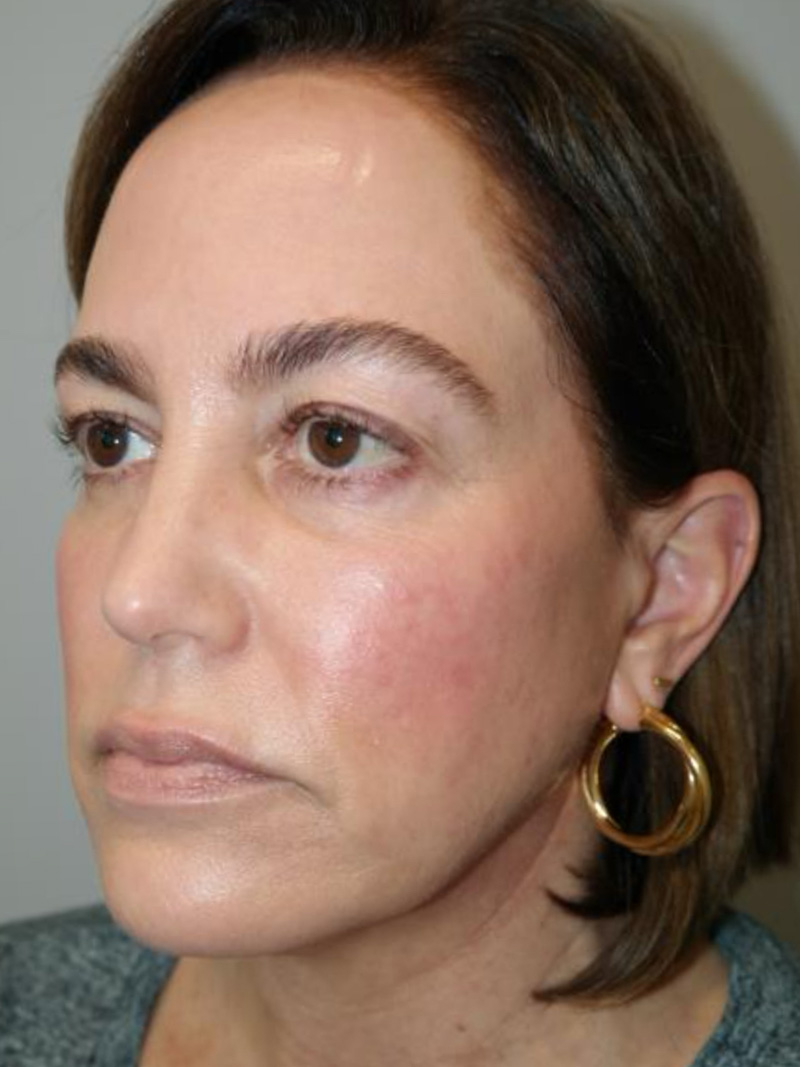 Facelift Before and After 20 | Grover Aesthetics