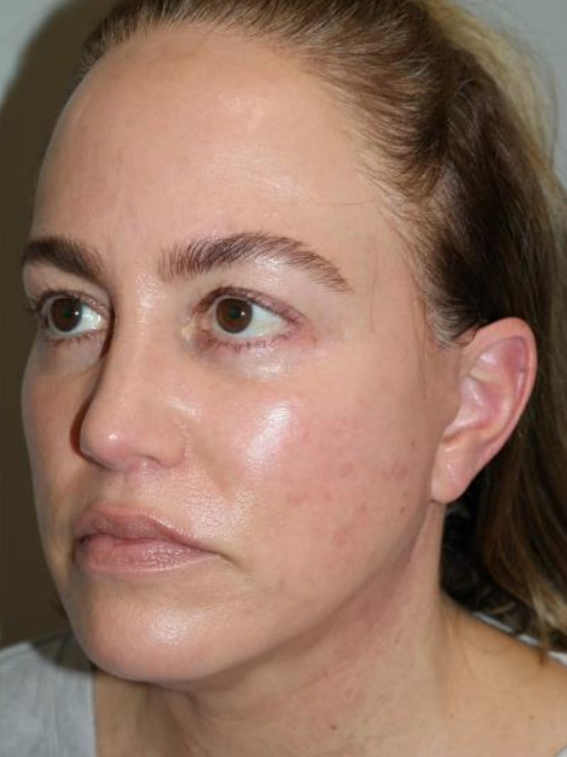 Facelift Before and After 20 | Grover Aesthetics