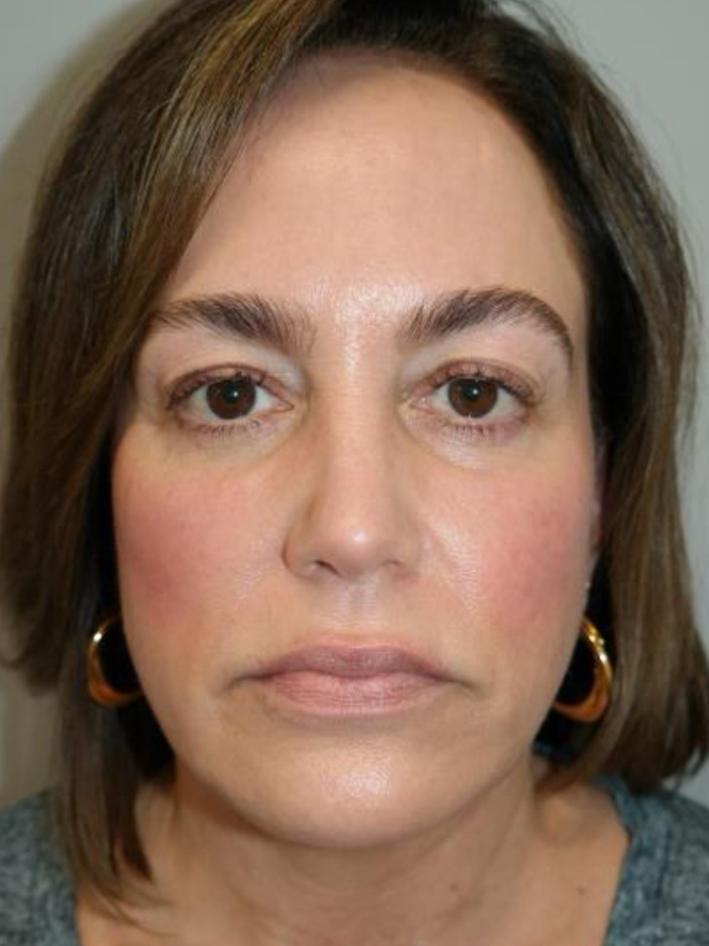Facelift Before and After 20 | Grover Aesthetics