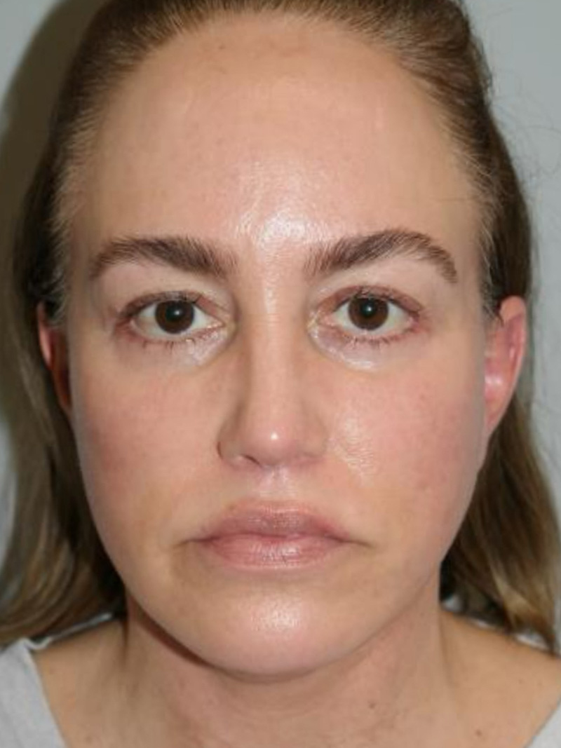 Facelift Before and After 20 | Grover Aesthetics