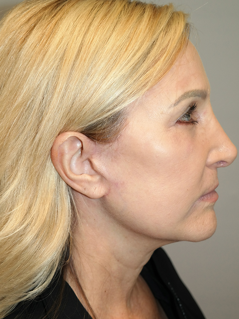 Facelift Before and After 21 | Grover Aesthetics