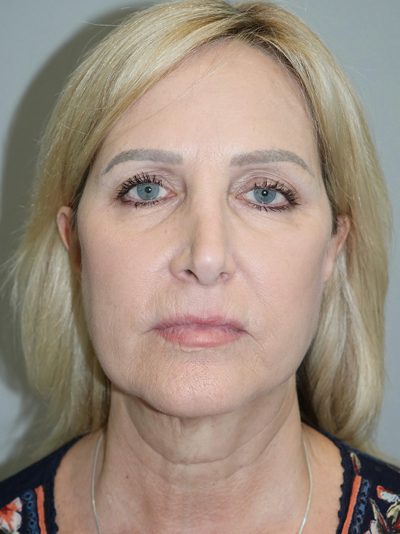 Facelift Before and After 21 | Grover Aesthetics