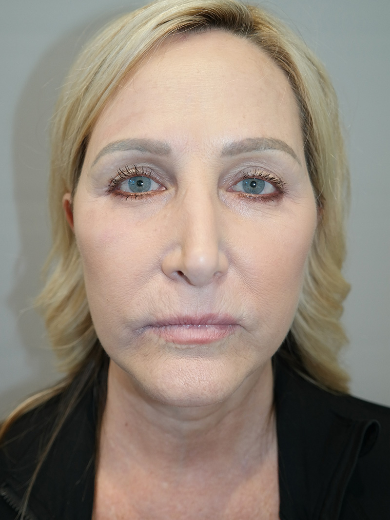 Facelift Before and After 21 | Grover Aesthetics