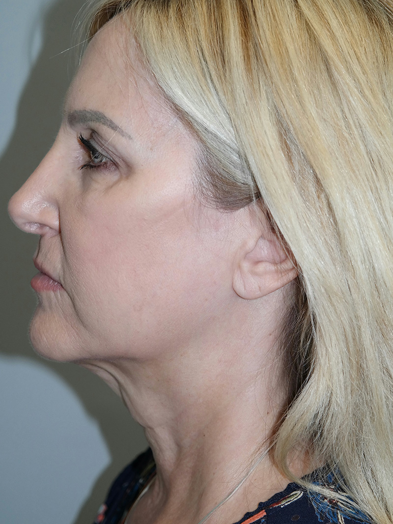 Facelift Before and After 21 | Grover Aesthetics