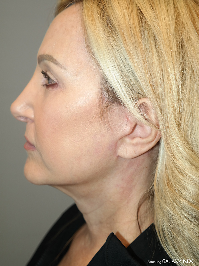 Facelift Before and After 21 | Grover Aesthetics