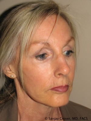 Facelift Before and After 10 | Sanjay Grover MD FACS