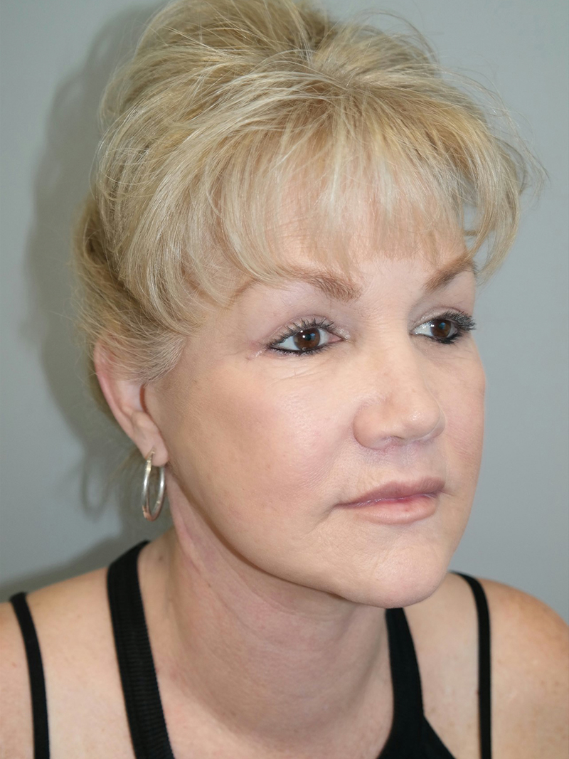 Facelift Before and After | Sanjay Grover MD FACS