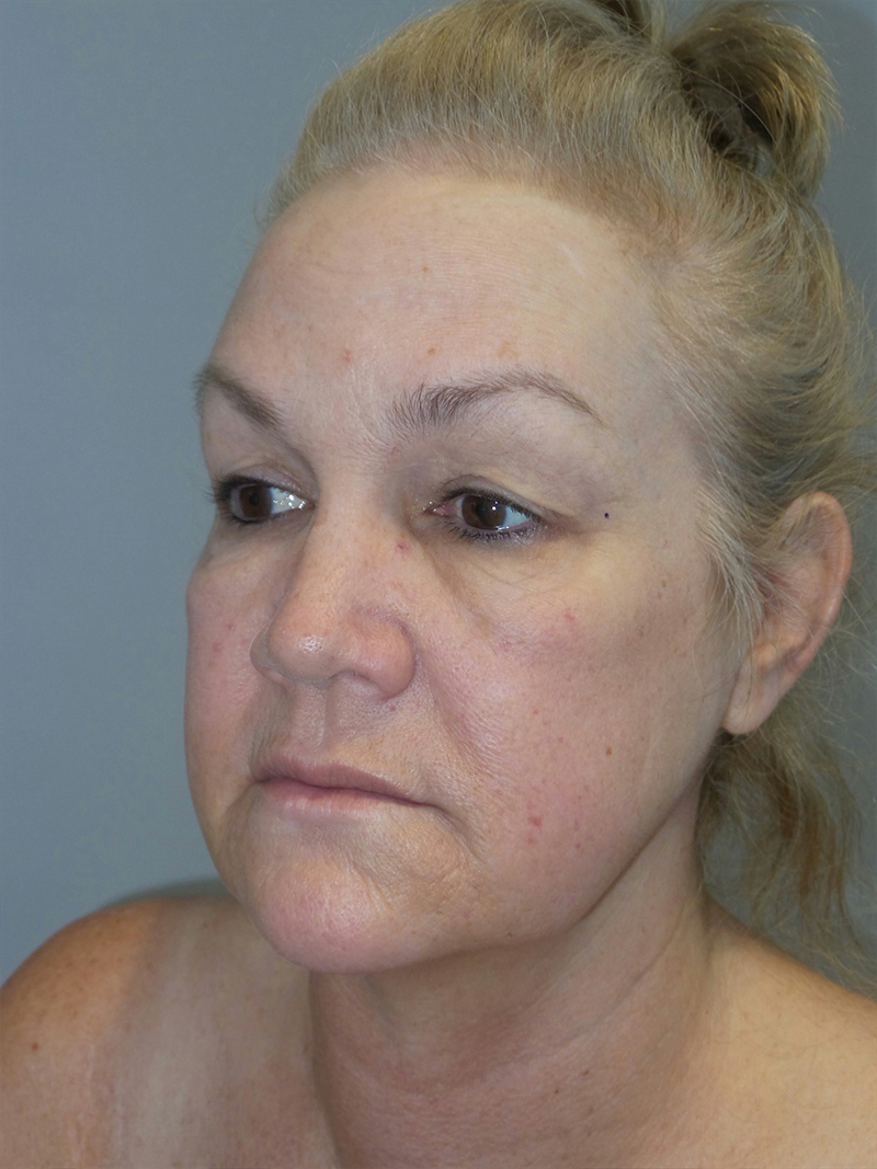 Facelift Before and After 22 | Grover Aesthetics