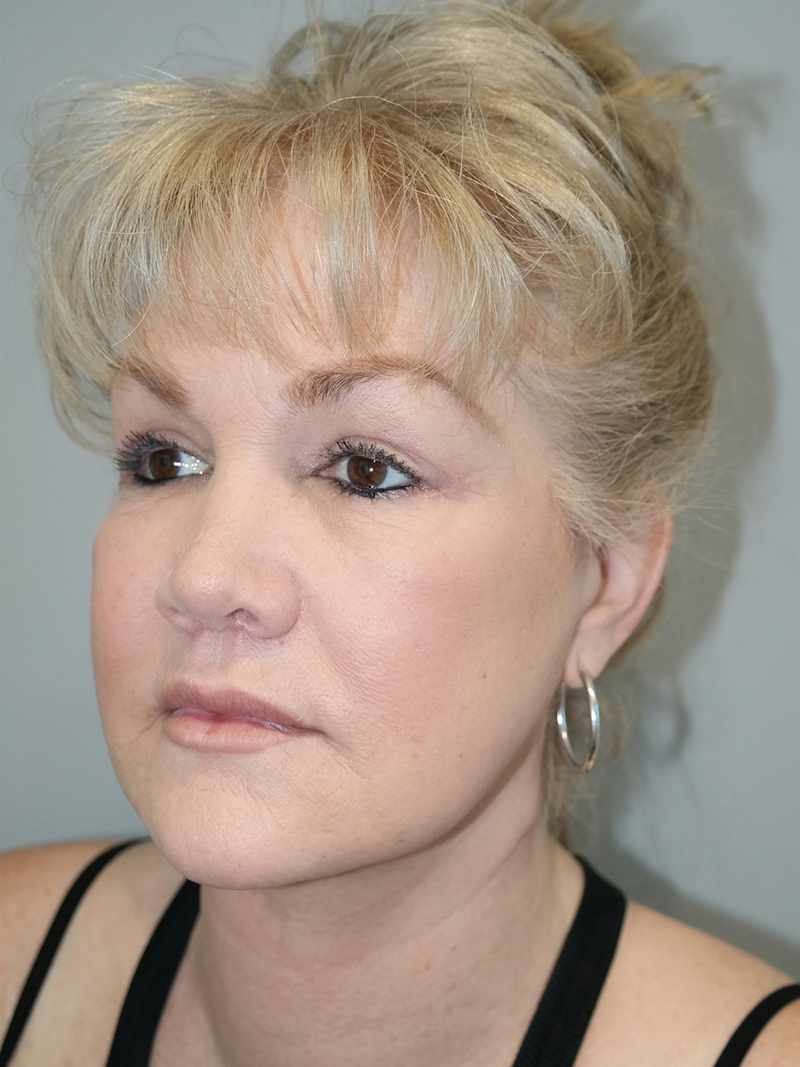 Facelift Before and After 22 | Sanjay Grover MD FACS