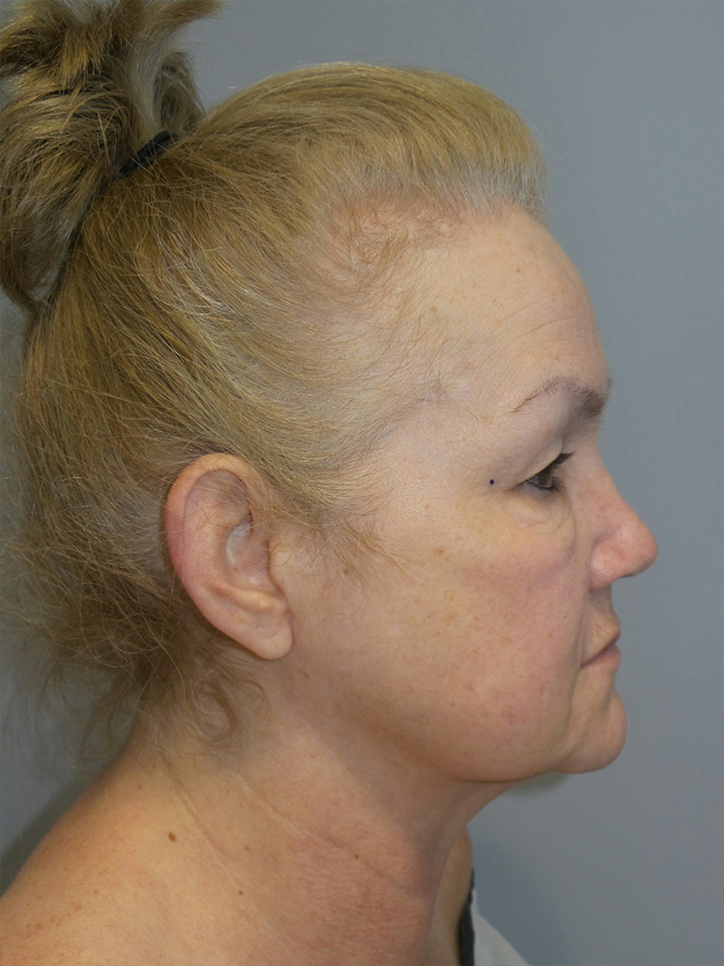 Facelift Before and After 22 | Sanjay Grover MD FACS