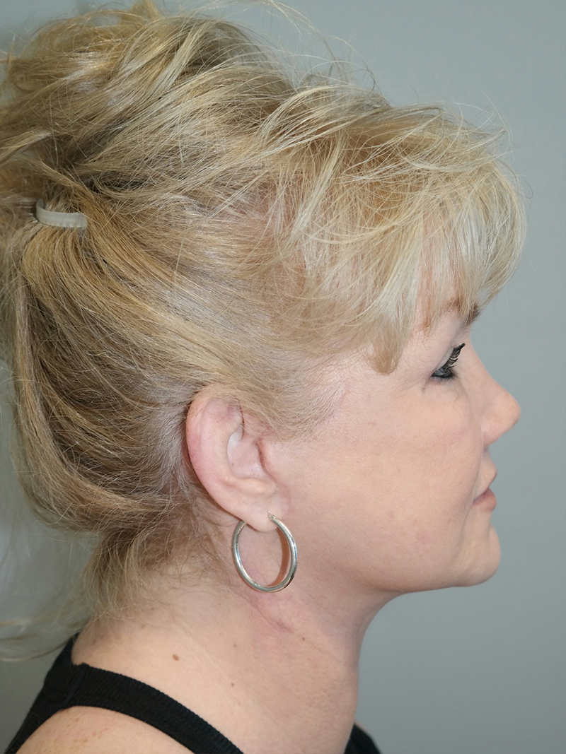 Facelift Before and After 22 | Sanjay Grover MD FACS