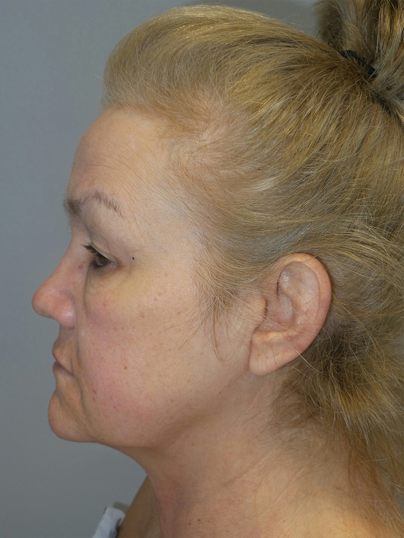 Facelift Before and After 22 | Sanjay Grover MD FACS