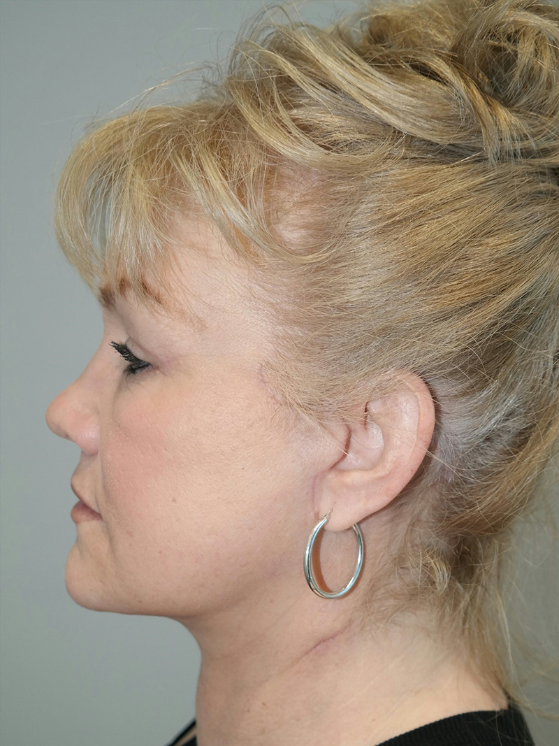 Facelift Before and After 22 | Sanjay Grover MD FACS