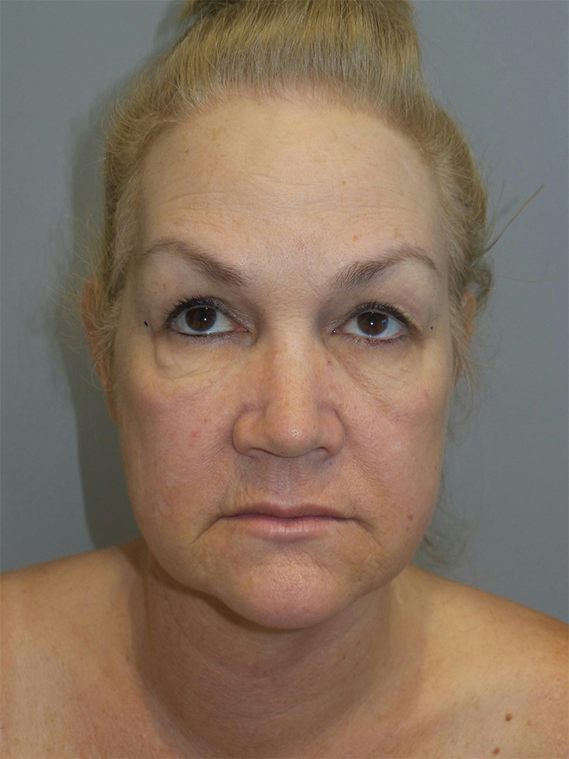 Facelift Before and After 22 | Grover Aesthetics