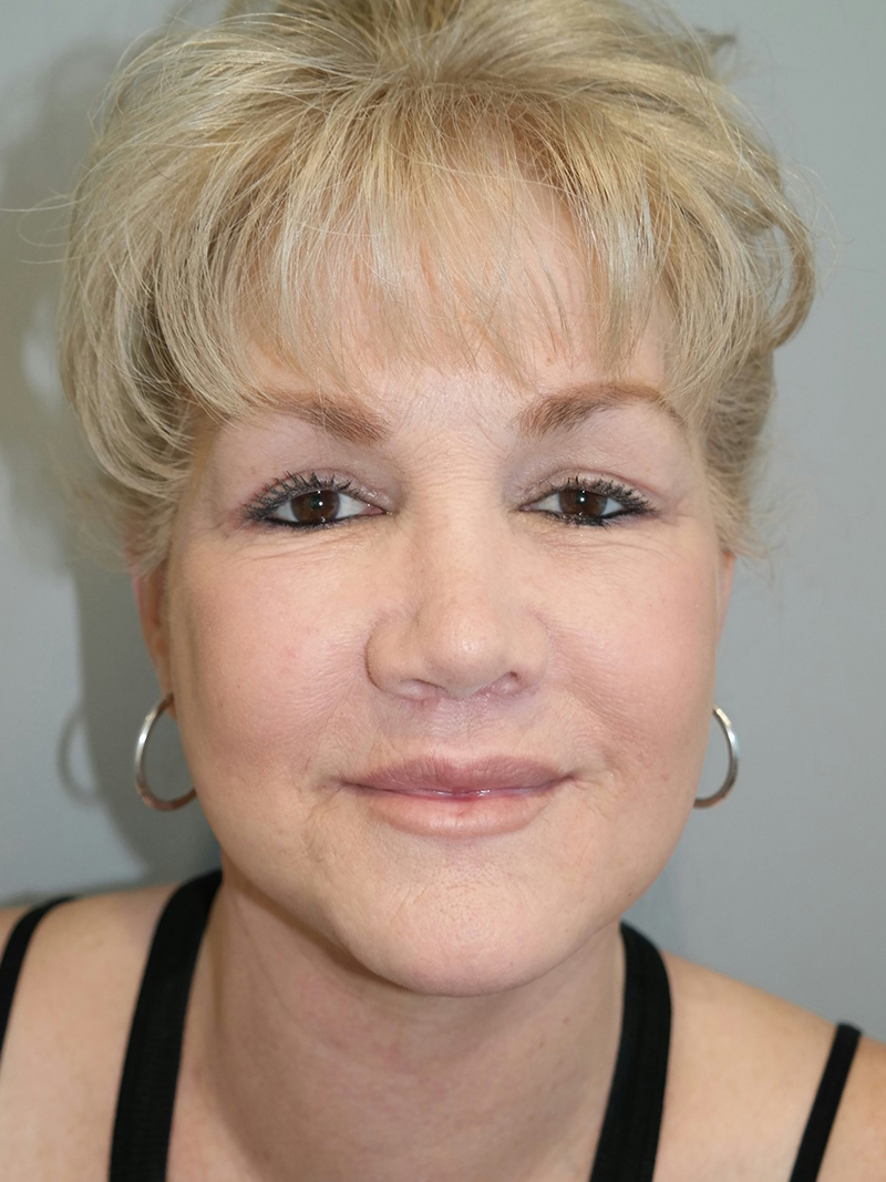 Facelift Before and After 22 | Sanjay Grover MD FACS