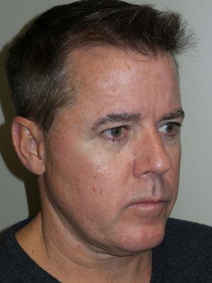 Facelift Before and After | Grover Aesthetics