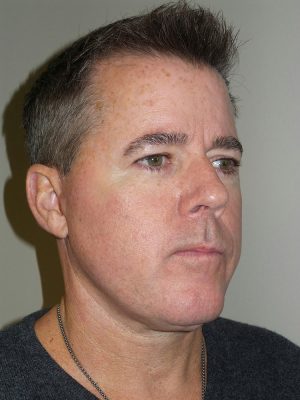 Facelift Before and After | Grover Aesthetics
